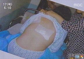 ▲ 피해학생이 병원에서 흉기에 찔린 부위를 드러내 보이고 있는 모습. ⓒ MBC뉴스 캡처