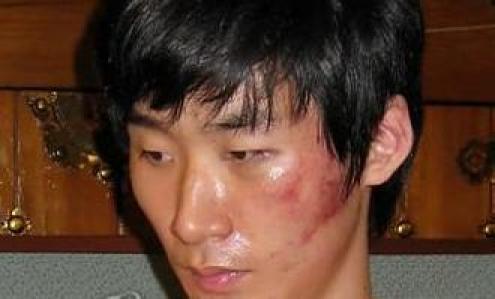 ▲ 코치에게 폭행당했다고 폭로하는 배구스타 박철우의 얼굴상처. (연합뉴스)
