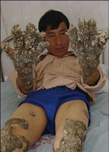 ▲ 린 티안쯔안의 손과 발에 산호 모양의 사마귀가 뒤덮여 있는 모습. ⓒ더선(http://www.thesun.co.uk)