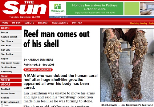 ▲ 린 티안쯔안의 손과 발에 산호 모양의 사마귀가 뒤덮여 있는 모습. ⓒ 더 선