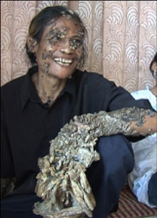 ▲ 원조 '나무인간' 인도네시아의 '디디 코스와라'&nbsp; ⓒ 더 선