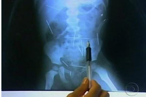 ▲ 2살 아기의 몸에 넣어진 바늘들. ⓒ자료사진