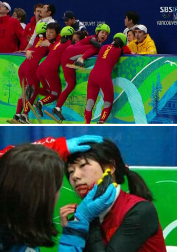 ▲ 얼굴에 상처를 입은 장후이 선수의 모습(사진 아래). ⓒ SBS 방송캡처