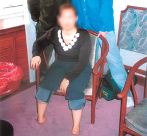 ▲ 북한 당국의 고문 후유증으로 두 발을 잘라낸 탈북자. ⓒ 자료사진
