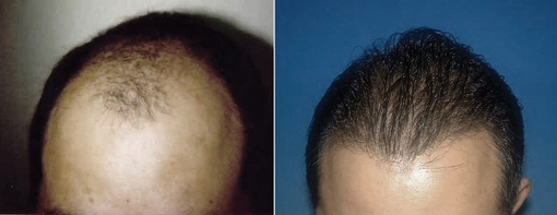 ▲ 모발이식 ⓒ 차병원 제공 