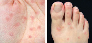 ▲ 수족구병은 입 안에 물집이나 손,발에 수포성 발진이 나타나는 증상을 보인다. ⓒ 자료사진