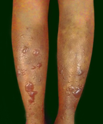 ▲ '비브리오 패혈증' 증상 ⓒ&nbsp;자료사진