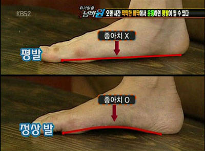 ▲ 잘못된 습관으로 후천적 평발이 될 수도 있다. ⓒ KBS 방송화면