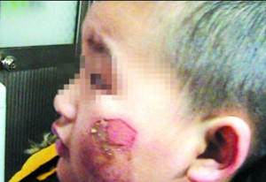 ▲ 교사가 다리미로 지진 어린이의 얼굴.ⓒ온바오닷컴 캡처