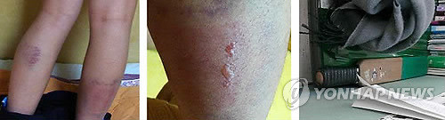 ▲ 지난해 경기도 수원 S고에서 문제가 된 체벌 피해 학생 모습. 이후 대부분 학교가 다소 체벌의 정도는 약해졌지만, 여전히 학생인권조례가 100% 지켜지고 있지는 않다.ⓒ연합뉴스