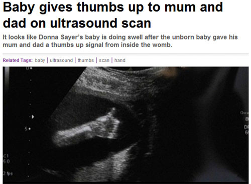 ▲ 엄지손가락을 치켜세운 듯한 동작을 보인 태아의 초음파 사진이 공개돼 화제다. ⓒ메트로 홈페지이 캡처