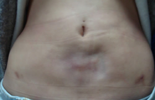 ▲ 부산의 한 병원에서 무면허 의사로부터 복부 지방흡입수술을 받고 난 뒤 부작용을 겪고 있는 환자의 복부 모습. ⓒ 금정경찰서 제공