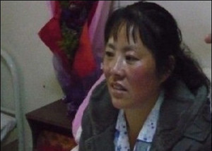 ▲ 체내에 무려 1만개가 넘는 결석이 검출된 여성.ⓒ온바오닷컴 캡처