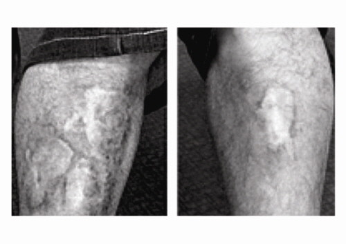 ▲ 2005년 신동혁씨가 14호 개천수용소를 탈출하다 전기철조망에 감전돼 생긴 흉터 ⓒ세이지