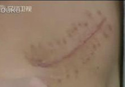 ▲ '아이패드2'를 사기 위해 벌인 신장 수술 자국.ⓒ온바오닷컴 캡처