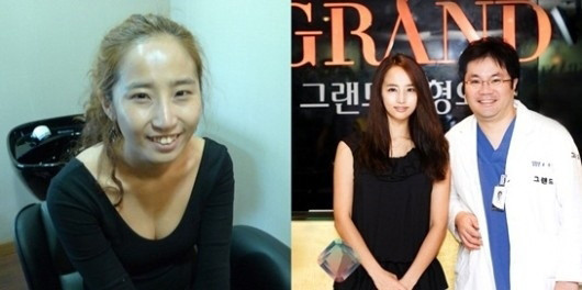 ▲ 최은 양악수술 ⓒ 사진=그랜드 성형외과 제공