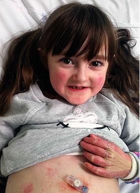 ▲ 희귀병 소녀 ⓒ 사진= 더 선 제공