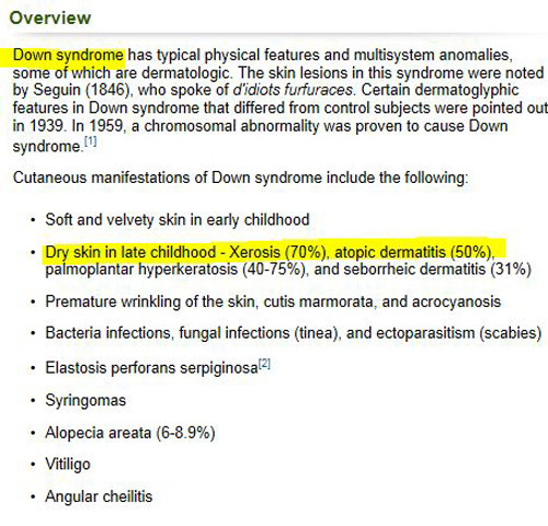 ▲ 22일 <빅뉴스>가 보도한 의학서적 내용 중 일부. 이 외에도 다운증후군 환자의 경우 피부가 약하고 혈액순환이 잘 안 돼 각종 질환을 겪기 쉬우며 노화가 빨리 온다는 설명이 있다.