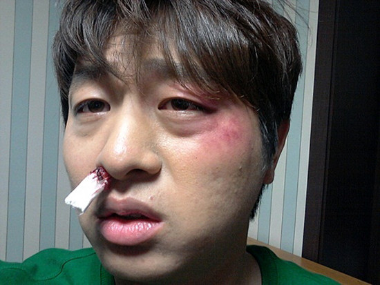 ▲ 유상무가 만신창이 얼굴을 공개했다. ⓒ 유상무 미투데이