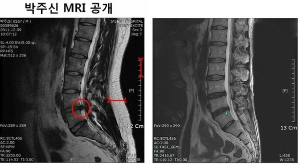 ▲ 무소속 강용석 의원이 공개한 박원순 시장 아들 박주신의 MRI 사진(좌) 키 173cm 63kg 박주신과 같은 체형을 가진 허리디스크 환자의 MRI 비교. 우측 사진을 보면 허리쪽 지방층이 거의 없다.