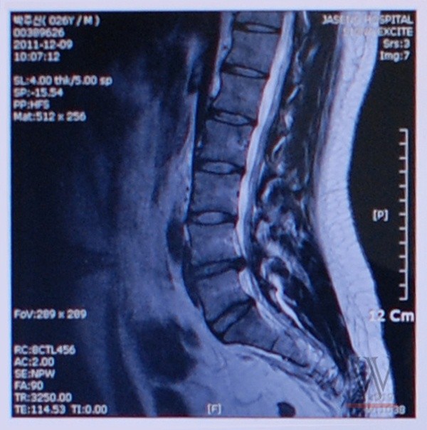 ▲ 문제의 MRI사진ⓒ