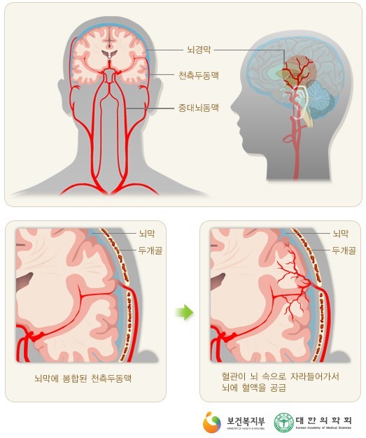 ▲ ⓒ모야모야병 수술도.