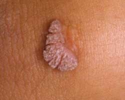 ▲ 인유두종바이러스(HPV)에 감염됐을 때 나타나는 증상 중 하나.