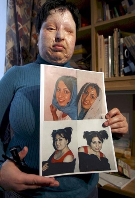 ▲ ⓒ조선일보-황산테러를 당한 이란여성 .