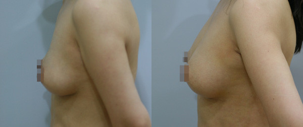 ▲ ⓒ수술전(왼쪽)과 지방이식과 보형물 수술 후(오른쪽) 모습.