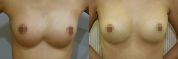 ▲ ⓒ가슴보형물 제거전(왼쪽)과 제거 후 지방이식 수술 후(오른쪽) 모습.