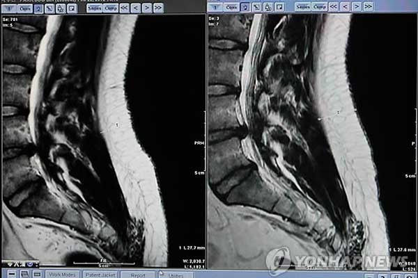 ▲ 언론에 공개됐던, 박원순 시장 아들 박주신 씨의 허리 MRI 사진. [사진: 연합뉴스]