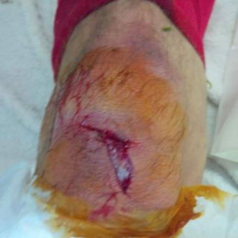 ▲ 아스날의 코시엘니가 자신의 페이스북에 부상 부위 사진을 공개했다. ⓒ코시엘니 페이스북