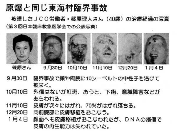 ▲ 日토카이무라 임계사고 당시 피폭자의 변화 사진. 이때나 후쿠시마 원전사태 때나 일본의 원전관리는 주먹구구식이다.