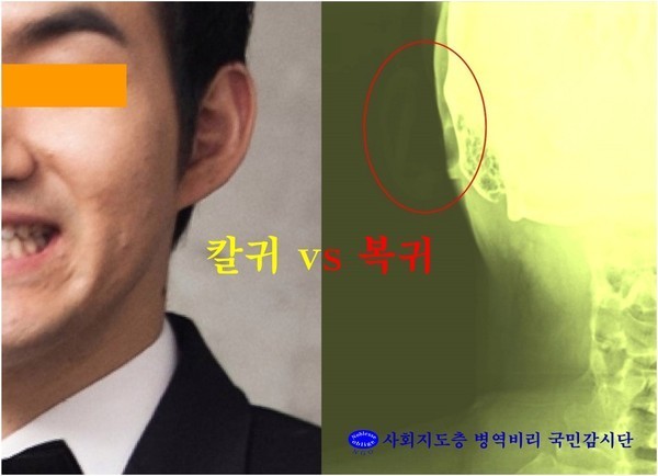 ▲ 박원순 서울시장의 아들 박주신씨의 X-RAY 사진. 얼핏 봐도 귀 모양이 확연히 다른 점이 눈에 띈다. ⓒ사진: 사회지도층 병역비리 국민감시단 제공