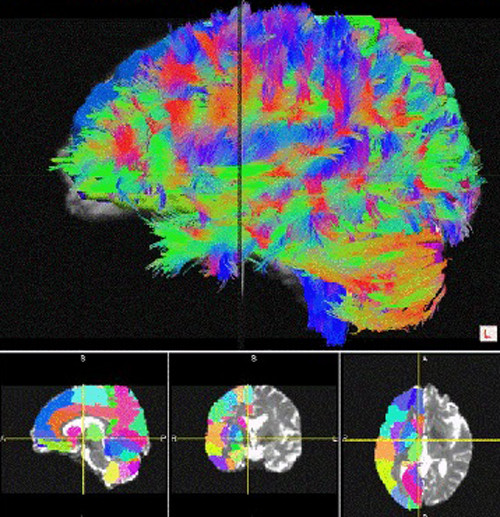 ▲ ▲ 확장텐서 MRI 영상을 이용한 뇌 회로 지도. 살아있는 사람에게서 큰스케일의 지도를 그릴 수 있다. ⓒ카이스트