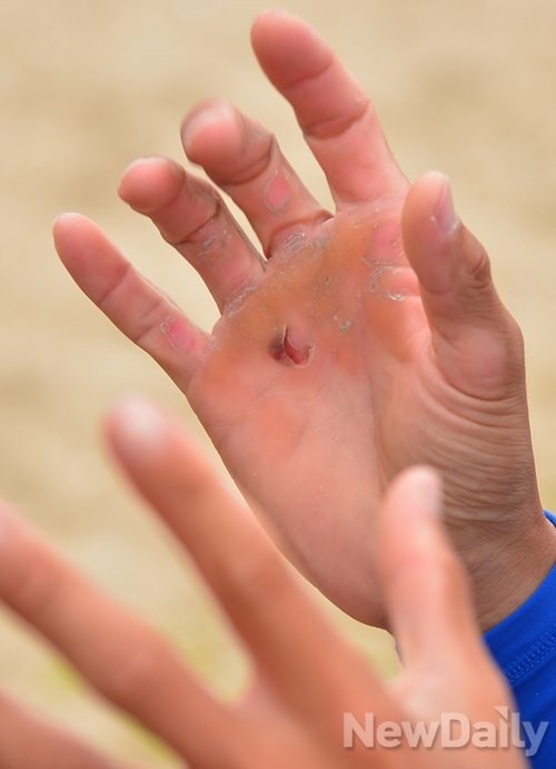 ▲ 굳은살로 가득한 이태훈 선수의 손바닥 ⓒ 정상윤