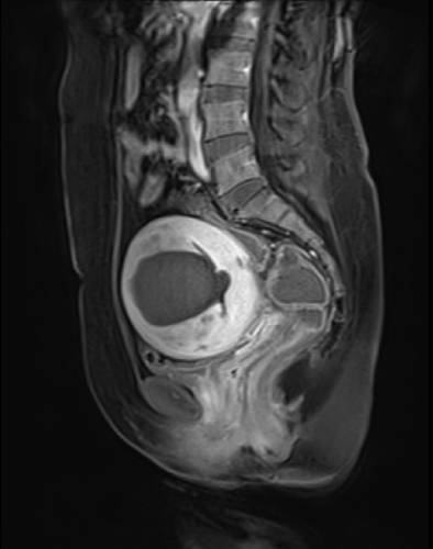 ▲ 하이푸시술로 치료를 받은 자궁선근증 환자의 자궁 MRI 촬영 모습ⓒ강남베드로병원