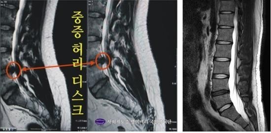 ▲ ▲ 2012년 2월 22일, 연세대 세브란스병원이 발표한 박주신 MRI(좌측)와 35세 남자의 비교 MRI(182cm/90kg).ⓒ 뉴데일리DB