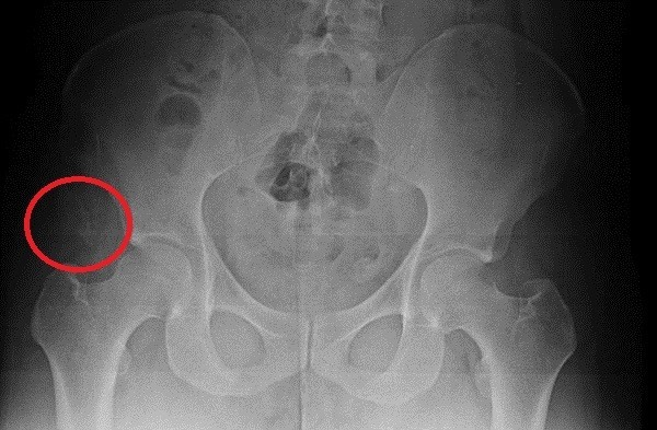 박주신씨의 골반 부위 X-Ray 사진.ⓒ 뉴데일리DB
