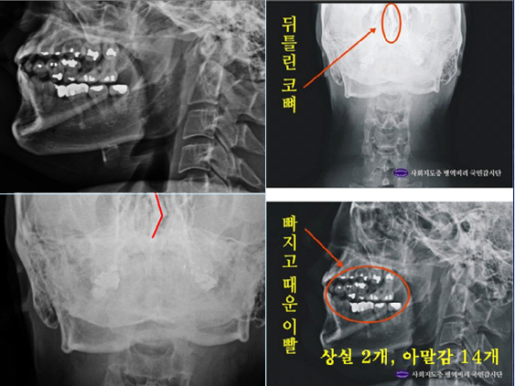 ▲ ▲ 박주신 엑스레이(X-RAY) 분석사진.ⓒ 뉴데일리DB