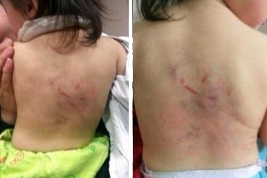▲ 부산의 한 어린이집에서 보육교사로부터 폭행당한 아이의 몸. ⓒ 자료사진