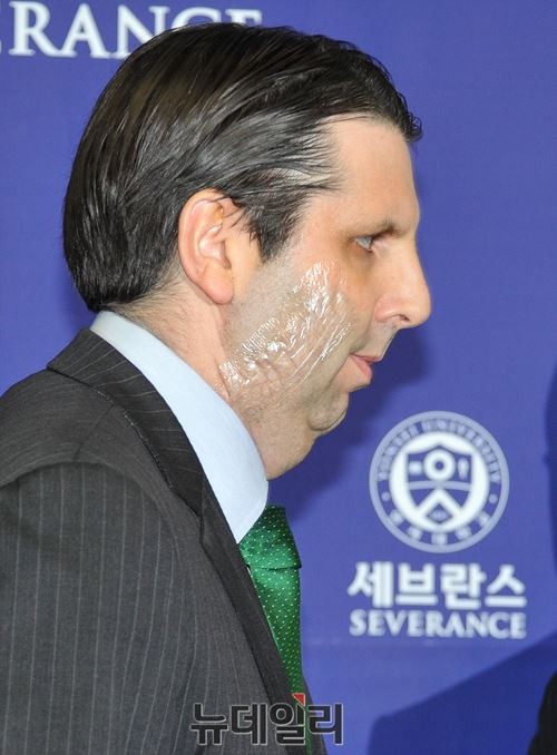 ▲ 마크 리퍼트 주한 미대사의 상처 ⓒ뉴데일리 이종현 기자