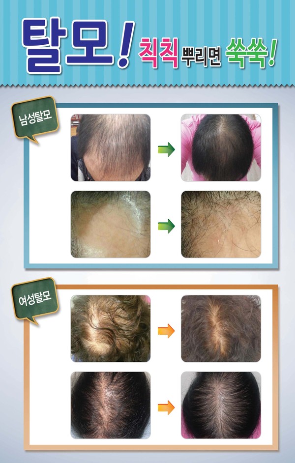 ▲ 10대 탈모로 시작해 오랫동안 고생한 박모씨(40세)의 임상사례.ⓒ㈜JW바이오 제공