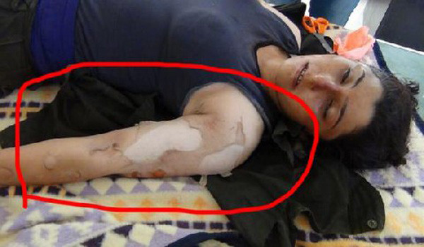 ▲ 2014년 가을, 테러조직 ISIS는 시리아 북부 쿠르드족에게 화학무기를 사용하기 시작했다고 한다. 사진은 수포작용제로 의심되는 화학무기 피해를 입은 여성. ⓒLiveleak 화면 캡쳐
