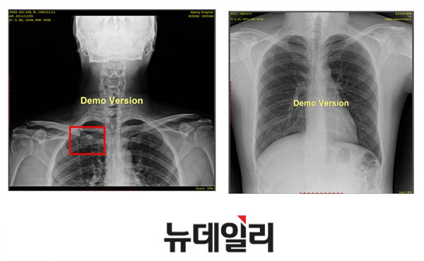 ▲ ▲박원순 서울시장의 아들 주신씨의 자생한방병원 엑스레이(왼쪽부터)와 공군교육사령부 엑스레이. 자생한방병원에는 늑골에 '석회화 현상'이 보이지만 공군 엑스레이에서는 발견되지 않는다. ⓒ 뉴데일리