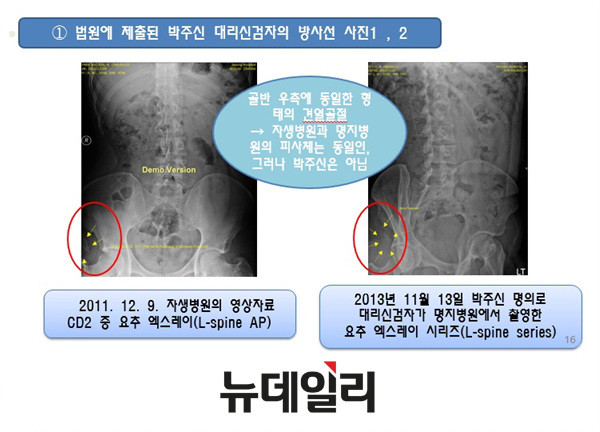 ▲ ▲자생한방병원과 명지병원에서 촬영한 박주신 엑스레이 영상자료. 오른쪽 골반에 견열골절이 보여 두 사진은 같은 것으로 나타났다. ⓒ 뉴데일리DB