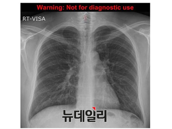 ▲ ▲세브란스에서 박주신이 비자발급을 위해 촬영한 엑스레이상에서도 제1흉추의 극상돌기는 오른쪽으로 휘어져 있다. ⓒ 뉴데일리