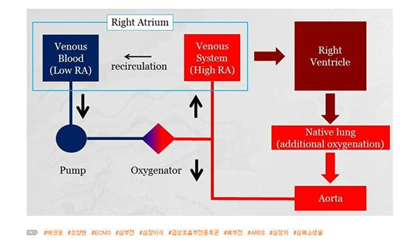 ▲ '에크모(ECMO)'에 대해 일반인들도 알기 쉽게 설명해 놓은 조양현 삼성서울병원 흉부외과 교수의 블로그. 조양현 교수는 이런 그림도 직접 그려서 올려 놓았다. ⓒ조양현 교수 블로그캡쳐