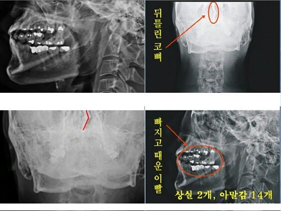 ▲ ▲박주신씨 명의의 치아 엑스레이(X-Ray). 구외 X-Ray 상에 나타나는 각종 의혹은, 허리 MRI와 더불어 해당 피사체가 주신씨가 아닐 가능성에 무게를 더한다.ⓒ 사회지도층병역비리감시단