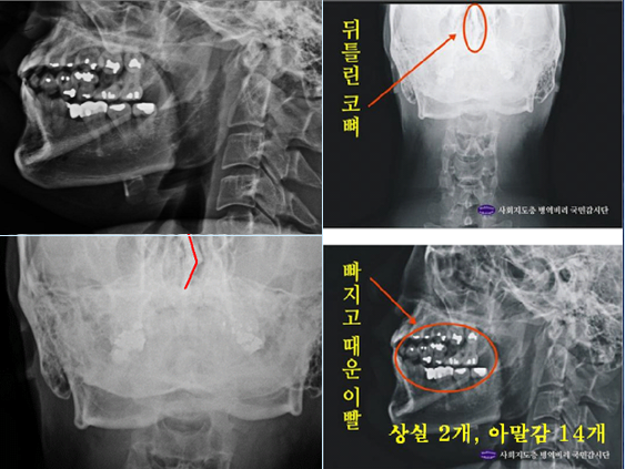 ▲ 박주신씨의 치아 상태를 알수 있는 엑스레이 사진 자료. ⓒ 뉴데일리DB